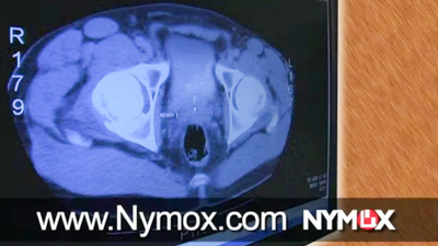 Nymox Prostate
